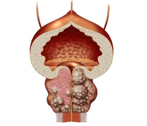 adenoma e edema de próstata e tratamento con cápsulas zxcvbnmqwert