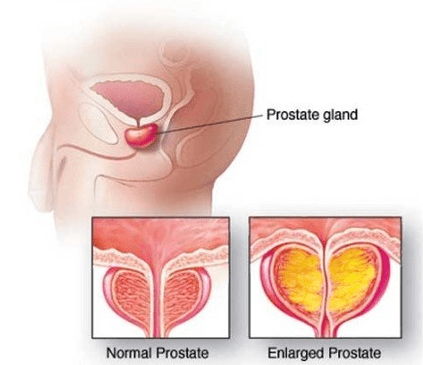 Próstata normal e inflamado