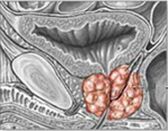 Prostatite crónica
