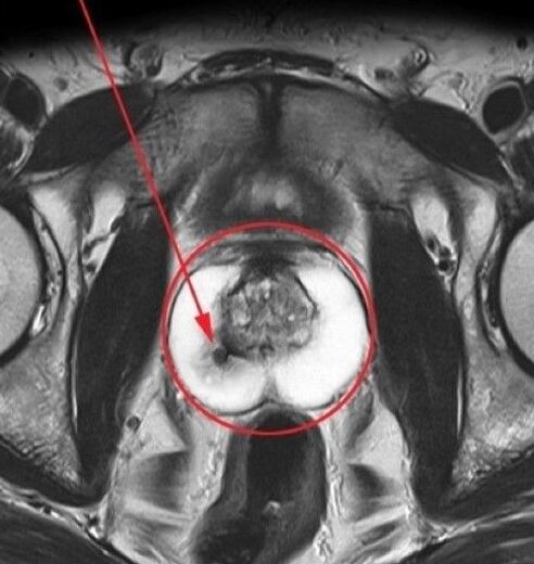 prostatite para ultrasóns antes de tomar UroSaf